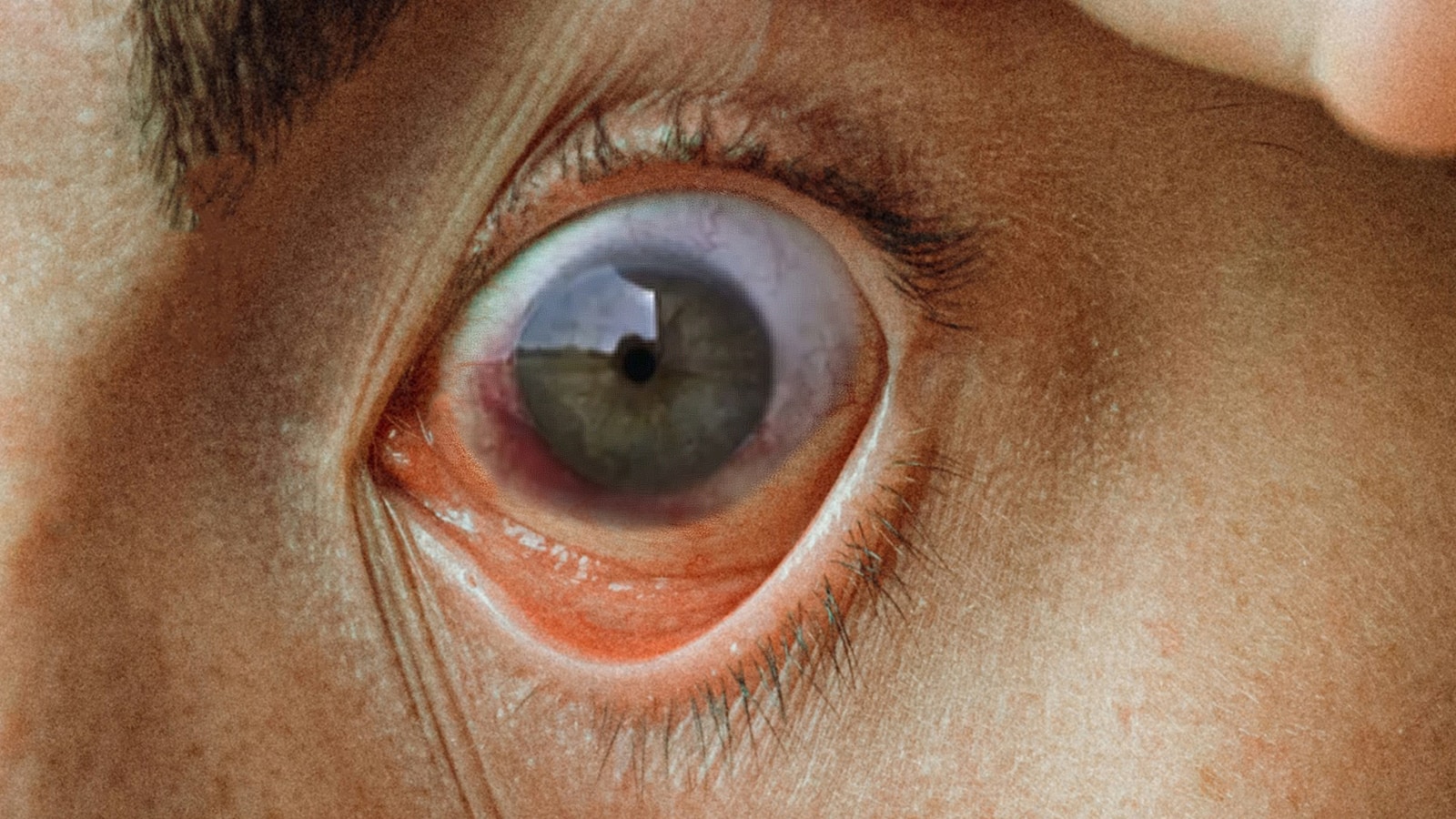 A close-up of a person's eye showing severe redness and irritation, a key symptom of eye infection.