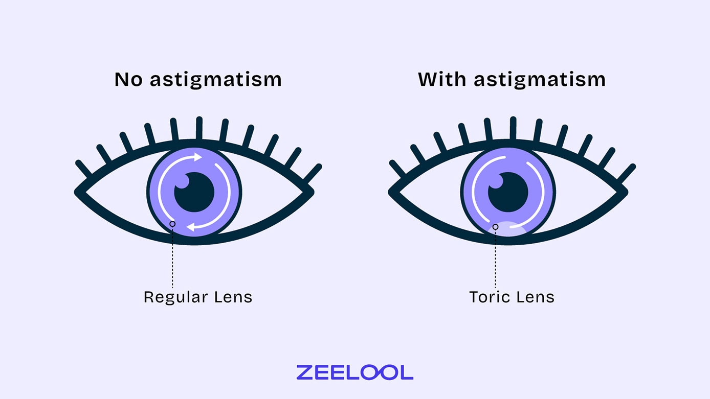 Toric Lenses vs Regular Lenses