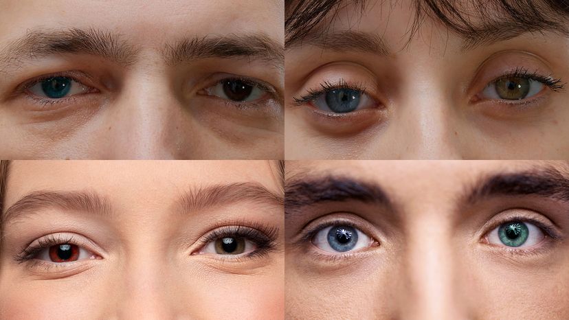 Types of Heterochromia: Causes and Variations