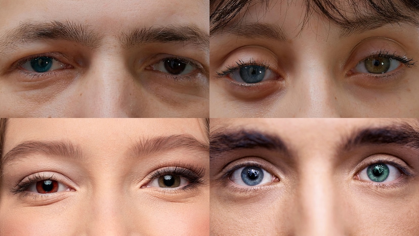 Types of Heterochromia: Causes and Variations