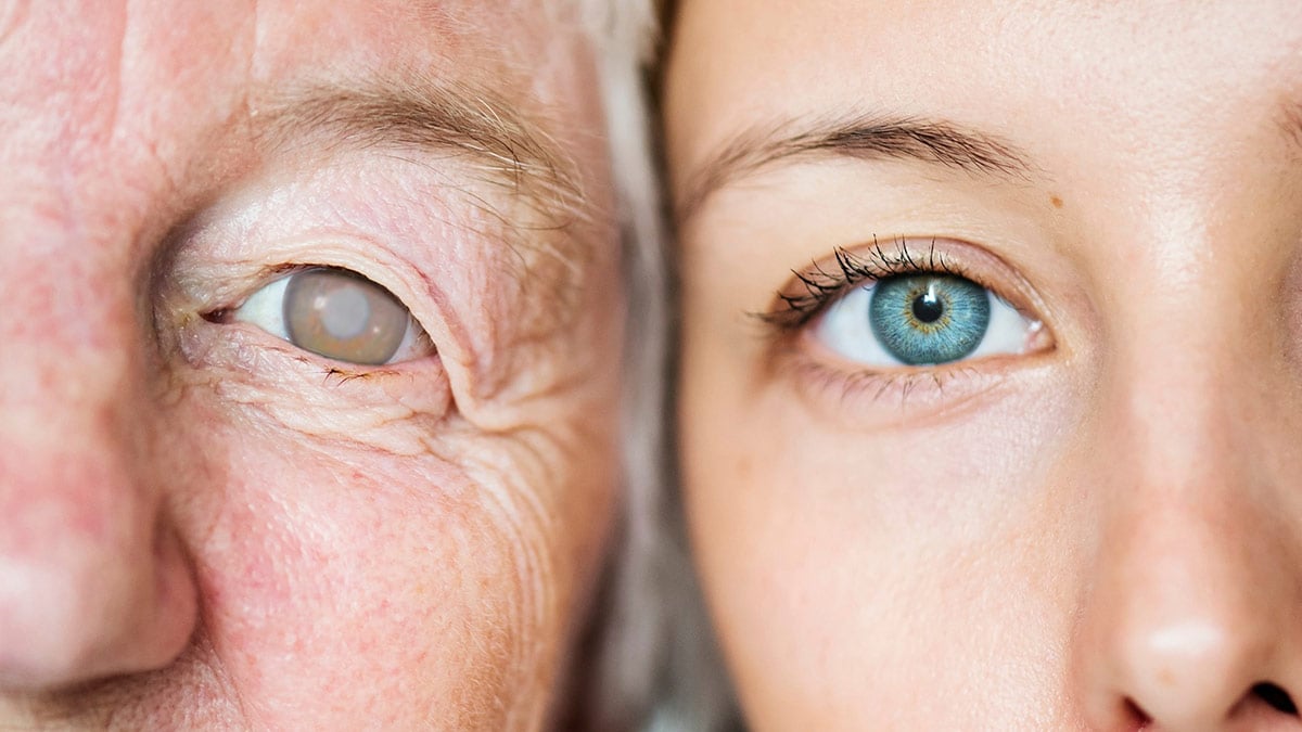 glaucoma or cataracts