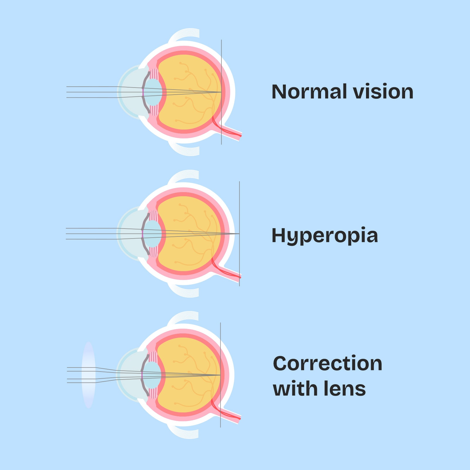 Diagrams showing normal vision, hyperopia with light focusing behind retina, and correction using plus lenses.